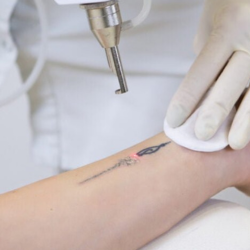 Eliminación de tatuajes